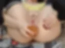 Huge Anal Prolapse 2